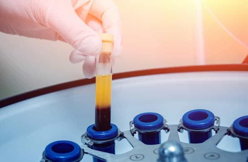 Tratamiento-Médico-plaquetas-PRP-2-Recuperar-el-pelo-perdido-Clínica-Capilar-FUExpert-Clinic-por-el-Dr-Juan-Couto-Madrid-España