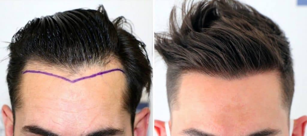 Antes y Después 2000 Injertos- Trasplante capilar FUE - Dr Juan Couto en clínica capilar FUExpert Clinic - Madrid, España