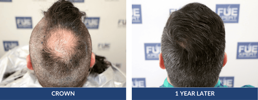 Before After Hair Transplant 1000 Grafts in Madrid by Dr. Juan Couto at FUExpert Clinic – Best Hair Transplant Clinic in Madrid, Spain, and the World 2 PHOTOS