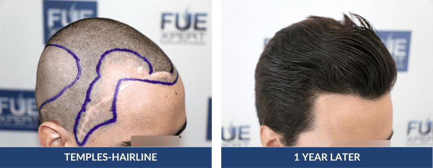 Before After Hair Transplant 2516 Grafts in Madrid by Dr. Juan Couto at FUExpert Clinic – Best Hair Transplant Clinic in Madrid, Spain, and the World 2 PHOTOS