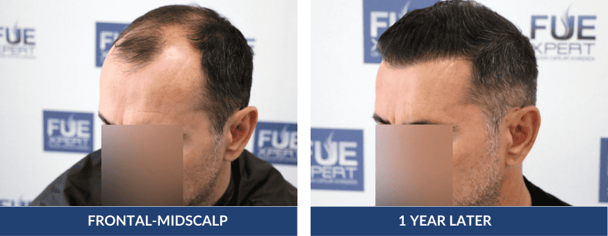 Before After Hair Transplant 3070 Grafts in Madrid by Dr. Juan Couto at FUExpert Clinic – Best Hair Transplant Clinic in Madrid, Spain, and the World 2 PHOTOS