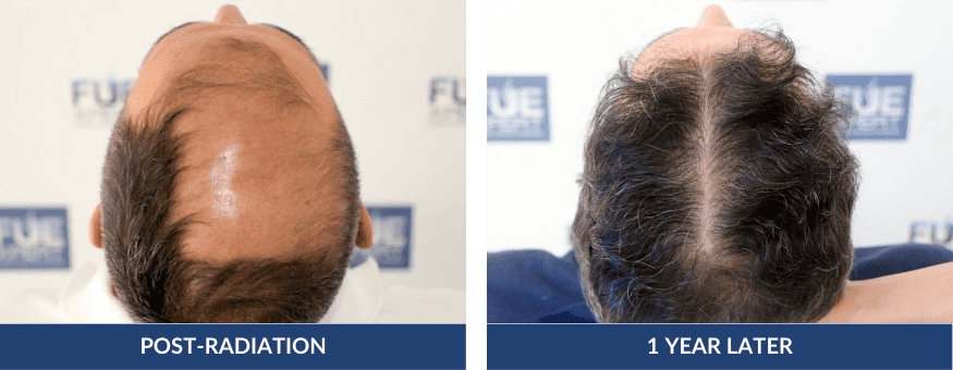 Before After Hair Transplant 5805 Grafts in Madrid by Dr. Juan Couto at FUExpert Clinic – Best Hair Transplant Clinic in Madrid, Spain, and the World 2 PHOTOS