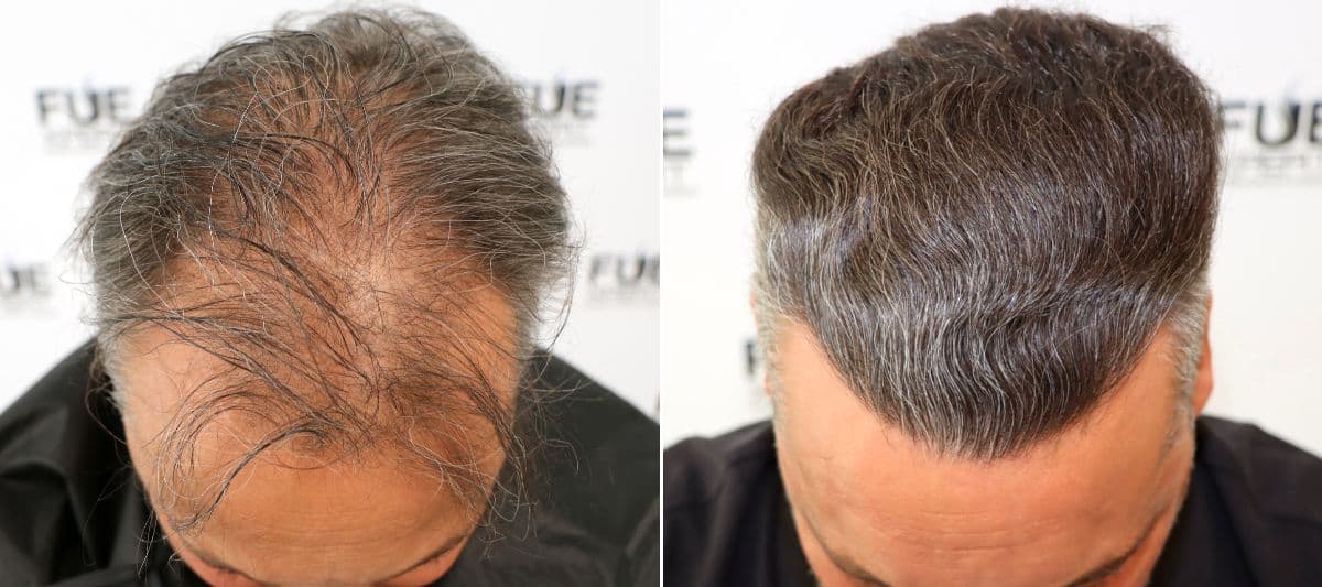 Antes-Despues-Trasplante-Capilar-3000-Grafts-por-el-Dr-Juan-Couto-en-FUExpert-Clinic-en-clinica-capilar-en-Madrid-FUExpert-Clinic